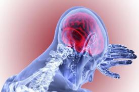 Penyebab dan Gejala Pendarahan Otak yang Perlu Diwaspadai